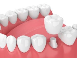 dental crown treatment advantages