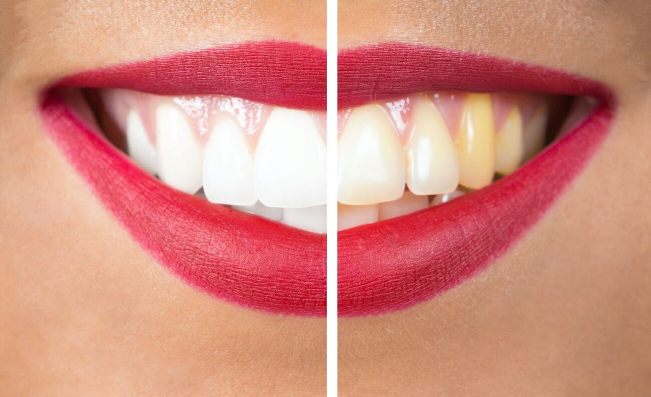 What Causes Dental Discoloration